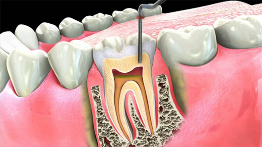 Breast Cancer Treatment in Chennai ,Thyroid  Cancer Treatment in Chennai, Surgical Oncologist Cancer Treatment in Chennai, Gastroenterology  in Chennai, Laparoscopic Surgery in Chennai,  Dentist in Chennai, Dental Clinic in Chennai, Dental in Chennai, Root Canal Treatment in Chennai,  endocrinologist in Chennai, Psychiatrist  in Chennai  Endodontist in Chennai, Breast Cancer Treatment in Purasawalkam Chennai ,Thyroid  Cancer Treatment in Purasawalkam Chennai, Surgical Oncologist Cancer Treatment in Purasawalkam Chennai, Gastroenterology  in Purasawalkam Chennai, Laparoscopic Surgery in Purasawalkam Chennai,  Dentist in Purasawalkam Chennai, Dental Clinic in Purasawalkam Chennai, Dental in Purasawalkam Chennai, Root Canal Treatment in Purasawalkam Chennai,  endocrinologist in Purasawalkam Chennai, Psychiatrist  in Purasawalkam Chennai  Endodontist in Purasawalkam Chennai, Breast Cancer Treatment in Vepery Chennai  ,Thyroid  Cancer Treatment in Vepery Chennai, Surgical Oncologist Cancer Treatment in Vepery Chennai, Gastroenterology  in Vepery Chennai, Laparoscopic Surgery in Vepery Chennai,  Dentist in Vepery Chennai, Dental Clinic in Vepery Chennai, Dental in Vepery Chennai, Root Canal Treatment in Vepery Chennai,  endocrinologist in Vepery Chennai, Psychiatrist  in Vepery Chennai  Endodontist in Vepery Chennai, , Breast Cancer Treatment in kilpauk Chennai  ,Thyroid  Cancer Treatment in kilpauk Chennai, Surgical Oncologist Cancer Treatment in kilpauk Chennai, Gastroenterology  in kilpauk Chennai, Laparoscopic Surgery in kilpauk Chennai,  Dentist in kilpauk Chennai, Dental Clinic in kilpauk Chennai, Dental in kilpauk Chennai, Root Canal Treatment in kilpauk Chennai,  endocrinologist in kilpauk Chennai, Psychiatrist  in kilpauk Chennai,  Endodontist in kilpauk Chennai, Breast Cancer Treatment in kellys Chennai  ,Thyroid  Cancer Treatment in kellys Chennai, Surgical Oncologist Cancer Treatment in kellys Chennai, Gastroenterology  in kellys Chennai, Laparoscopic Surgery in kellys Chennai,  Dentist in kellys Chennai, Dental Clinic in kellys Chennai, Dental in kellys Chennai, Root Canal Treatment in kellys Chennai,  endocrinologist in kellys Chennai, Psychiatrist  in kellys Chennai,  Endodontist in kellys Chennai