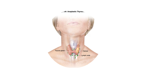 Breast Cancer Treatment in Chennai ,Thyroid  Cancer Treatment in Chennai, Surgical Oncologist Cancer Treatment in Chennai, Gastroenterology  in Chennai, Laparoscopic Surgery in Chennai,  Dentist in Chennai, Dental Clinic in Chennai, Dental in Chennai, Root Canal Treatment in Chennai,  endocrinologist in Chennai, Psychiatrist  in Chennai  Endodontist in Chennai, Breast Cancer Treatment in Purasawalkam Chennai ,Thyroid  Cancer Treatment in Purasawalkam Chennai, Surgical Oncologist Cancer Treatment in Purasawalkam Chennai, Gastroenterology  in Purasawalkam Chennai, Laparoscopic Surgery in Purasawalkam Chennai,  Dentist in Purasawalkam Chennai, Dental Clinic in Purasawalkam Chennai, Dental in Purasawalkam Chennai, Root Canal Treatment in Purasawalkam Chennai,  endocrinologist in Purasawalkam Chennai, Psychiatrist  in Purasawalkam Chennai  Endodontist in Purasawalkam Chennai, Breast Cancer Treatment in Vepery Chennai  ,Thyroid  Cancer Treatment in Vepery Chennai, Surgical Oncologist Cancer Treatment in Vepery Chennai, Gastroenterology  in Vepery Chennai, Laparoscopic Surgery in Vepery Chennai,  Dentist in Vepery Chennai, Dental Clinic in Vepery Chennai, Dental in Vepery Chennai, Root Canal Treatment in Vepery Chennai,  endocrinologist in Vepery Chennai, Psychiatrist  in Vepery Chennai  Endodontist in Vepery Chennai, , Breast Cancer Treatment in kilpauk Chennai  ,Thyroid  Cancer Treatment in kilpauk Chennai, Surgical Oncologist Cancer Treatment in kilpauk Chennai, Gastroenterology  in kilpauk Chennai, Laparoscopic Surgery in kilpauk Chennai,  Dentist in kilpauk Chennai, Dental Clinic in kilpauk Chennai, Dental in kilpauk Chennai, Root Canal Treatment in kilpauk Chennai,  endocrinologist in kilpauk Chennai, Psychiatrist  in kilpauk Chennai,  Endodontist in kilpauk Chennai, Breast Cancer Treatment in kellys Chennai  ,Thyroid  Cancer Treatment in kellys Chennai, Surgical Oncologist Cancer Treatment in kellys Chennai, Gastroenterology  in kellys Chennai, Laparoscopic Surgery in kellys Chennai,  Dentist in kellys Chennai, Dental Clinic in kellys Chennai, Dental in kellys Chennai, Root Canal Treatment in kellys Chennai,  endocrinologist in kellys Chennai, Psychiatrist  in kellys Chennai,  Endodontist in kellys Chennai