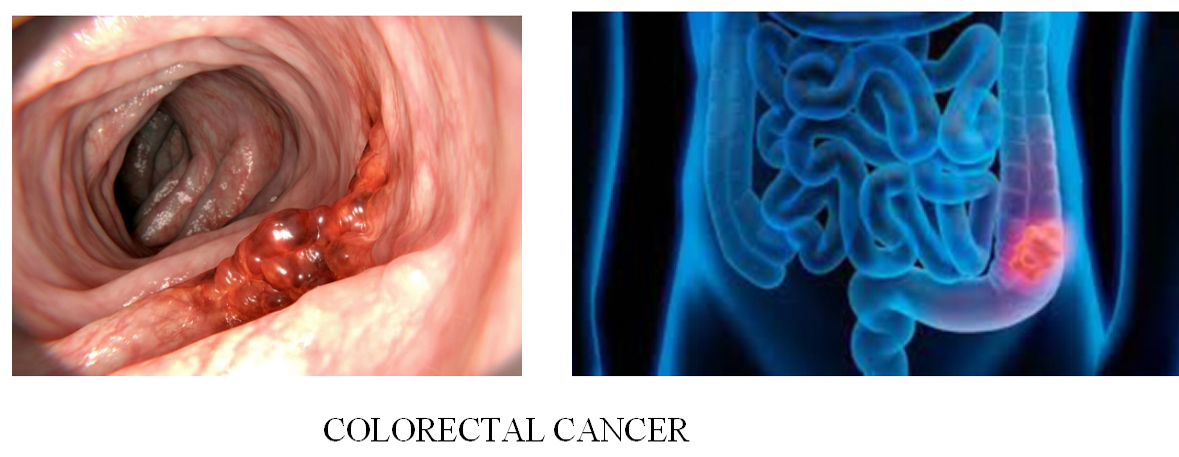 Breast Cancer Treatment in Chennai ,Thyroid  Cancer Treatment in Chennai, Surgical Oncologist Cancer Treatment in Chennai, Gastroenterology  in Chennai, Laparoscopic Surgery in Chennai,  Dentist in Chennai, Dental Clinic in Chennai, Dental in Chennai, Root Canal Treatment in Chennai,  endocrinologist in Chennai, Psychiatrist  in Chennai  Endodontist in Chennai, Breast Cancer Treatment in Purasawalkam Chennai ,Thyroid  Cancer Treatment in Purasawalkam Chennai, Surgical Oncologist Cancer Treatment in Purasawalkam Chennai, Gastroenterology  in Purasawalkam Chennai, Laparoscopic Surgery in Purasawalkam Chennai,  Dentist in Purasawalkam Chennai, Dental Clinic in Purasawalkam Chennai, Dental in Purasawalkam Chennai, Root Canal Treatment in Purasawalkam Chennai,  endocrinologist in Purasawalkam Chennai, Psychiatrist  in Purasawalkam Chennai  Endodontist in Purasawalkam Chennai, Breast Cancer Treatment in Vepery Chennai  ,Thyroid  Cancer Treatment in Vepery Chennai, Surgical Oncologist Cancer Treatment in Vepery Chennai, Gastroenterology  in Vepery Chennai, Laparoscopic Surgery in Vepery Chennai,  Dentist in Vepery Chennai, Dental Clinic in Vepery Chennai, Dental in Vepery Chennai, Root Canal Treatment in Vepery Chennai,  endocrinologist in Vepery Chennai, Psychiatrist  in Vepery Chennai  Endodontist in Vepery Chennai, , Breast Cancer Treatment in kilpauk Chennai  ,Thyroid  Cancer Treatment in kilpauk Chennai, Surgical Oncologist Cancer Treatment in kilpauk Chennai, Gastroenterology  in kilpauk Chennai, Laparoscopic Surgery in kilpauk Chennai,  Dentist in kilpauk Chennai, Dental Clinic in kilpauk Chennai, Dental in kilpauk Chennai, Root Canal Treatment in kilpauk Chennai,  endocrinologist in kilpauk Chennai, Psychiatrist  in kilpauk Chennai,  Endodontist in kilpauk Chennai, Breast Cancer Treatment in kellys Chennai  ,Thyroid  Cancer Treatment in kellys Chennai, Surgical Oncologist Cancer Treatment in kellys Chennai, Gastroenterology  in kellys Chennai, Laparoscopic Surgery in kellys Chennai,  Dentist in kellys Chennai, Dental Clinic in kellys Chennai, Dental in kellys Chennai, Root Canal Treatment in kellys Chennai,  endocrinologist in kellys Chennai, Psychiatrist  in kellys Chennai,  Endodontist in kellys Chennai