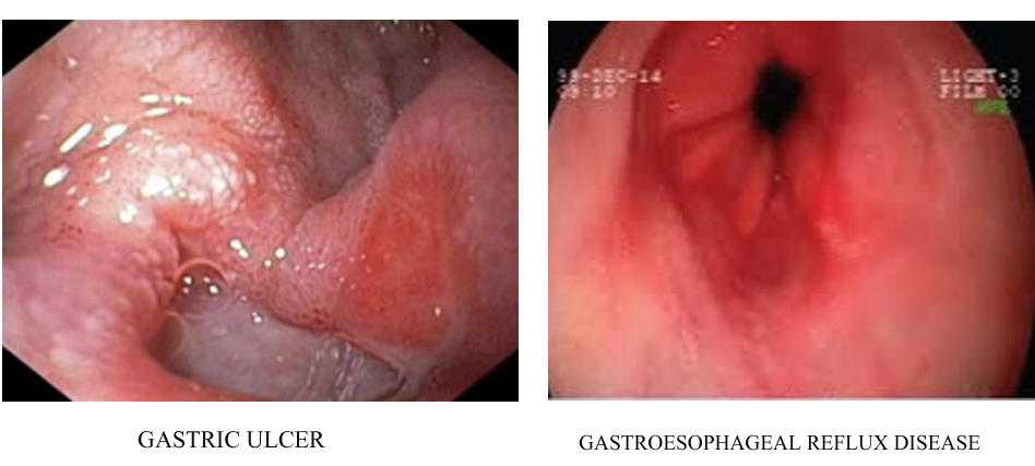 Breast Cancer Treatment in Chennai ,Thyroid  Cancer Treatment in Chennai, Surgical Oncologist Cancer Treatment in Chennai, Gastroenterology  in Chennai, Laparoscopic Surgery in Chennai,  Dentist in Chennai, Dental Clinic in Chennai, Dental in Chennai, Root Canal Treatment in Chennai,  endocrinologist in Chennai, Psychiatrist  in Chennai  Endodontist in Chennai, Breast Cancer Treatment in Purasawalkam Chennai ,Thyroid  Cancer Treatment in Purasawalkam Chennai, Surgical Oncologist Cancer Treatment in Purasawalkam Chennai, Gastroenterology  in Purasawalkam Chennai, Laparoscopic Surgery in Purasawalkam Chennai,  Dentist in Purasawalkam Chennai, Dental Clinic in Purasawalkam Chennai, Dental in Purasawalkam Chennai, Root Canal Treatment in Purasawalkam Chennai,  endocrinologist in Purasawalkam Chennai, Psychiatrist  in Purasawalkam Chennai  Endodontist in Purasawalkam Chennai, Breast Cancer Treatment in Vepery Chennai  ,Thyroid  Cancer Treatment in Vepery Chennai, Surgical Oncologist Cancer Treatment in Vepery Chennai, Gastroenterology  in Vepery Chennai, Laparoscopic Surgery in Vepery Chennai,  Dentist in Vepery Chennai, Dental Clinic in Vepery Chennai, Dental in Vepery Chennai, Root Canal Treatment in Vepery Chennai,  endocrinologist in Vepery Chennai, Psychiatrist  in Vepery Chennai  Endodontist in Vepery Chennai, , Breast Cancer Treatment in kilpauk Chennai  ,Thyroid  Cancer Treatment in kilpauk Chennai, Surgical Oncologist Cancer Treatment in kilpauk Chennai, Gastroenterology  in kilpauk Chennai, Laparoscopic Surgery in kilpauk Chennai,  Dentist in kilpauk Chennai, Dental Clinic in kilpauk Chennai, Dental in kilpauk Chennai, Root Canal Treatment in kilpauk Chennai,  endocrinologist in kilpauk Chennai, Psychiatrist  in kilpauk Chennai,  Endodontist in kilpauk Chennai, Breast Cancer Treatment in kellys Chennai  ,Thyroid  Cancer Treatment in kellys Chennai, Surgical Oncologist Cancer Treatment in kellys Chennai, Gastroenterology  in kellys Chennai, Laparoscopic Surgery in kellys Chennai,  Dentist in kellys Chennai, Dental Clinic in kellys Chennai, Dental in kellys Chennai, Root Canal Treatment in kellys Chennai,  endocrinologist in kellys Chennai, Psychiatrist  in kellys Chennai,  Endodontist in kellys Chennai