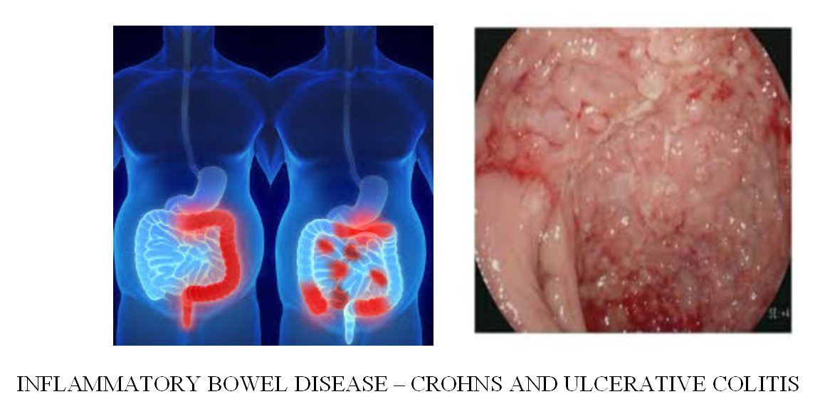 Breast Cancer Treatment in Chennai ,Thyroid  Cancer Treatment in Chennai, Surgical Oncologist Cancer Treatment in Chennai, Gastroenterology  in Chennai, Laparoscopic Surgery in Chennai,  Dentist in Chennai, Dental Clinic in Chennai, Dental in Chennai, Root Canal Treatment in Chennai,  endocrinologist in Chennai, Psychiatrist  in Chennai  Endodontist in Chennai, Breast Cancer Treatment in Purasawalkam Chennai ,Thyroid  Cancer Treatment in Purasawalkam Chennai, Surgical Oncologist Cancer Treatment in Purasawalkam Chennai, Gastroenterology  in Purasawalkam Chennai, Laparoscopic Surgery in Purasawalkam Chennai,  Dentist in Purasawalkam Chennai, Dental Clinic in Purasawalkam Chennai, Dental in Purasawalkam Chennai, Root Canal Treatment in Purasawalkam Chennai,  endocrinologist in Purasawalkam Chennai, Psychiatrist  in Purasawalkam Chennai  Endodontist in Purasawalkam Chennai, Breast Cancer Treatment in Vepery Chennai  ,Thyroid  Cancer Treatment in Vepery Chennai, Surgical Oncologist Cancer Treatment in Vepery Chennai, Gastroenterology  in Vepery Chennai, Laparoscopic Surgery in Vepery Chennai,  Dentist in Vepery Chennai, Dental Clinic in Vepery Chennai, Dental in Vepery Chennai, Root Canal Treatment in Vepery Chennai,  endocrinologist in Vepery Chennai, Psychiatrist  in Vepery Chennai  Endodontist in Vepery Chennai, , Breast Cancer Treatment in kilpauk Chennai  ,Thyroid  Cancer Treatment in kilpauk Chennai, Surgical Oncologist Cancer Treatment in kilpauk Chennai, Gastroenterology  in kilpauk Chennai, Laparoscopic Surgery in kilpauk Chennai,  Dentist in kilpauk Chennai, Dental Clinic in kilpauk Chennai, Dental in kilpauk Chennai, Root Canal Treatment in kilpauk Chennai,  endocrinologist in kilpauk Chennai, Psychiatrist  in kilpauk Chennai,  Endodontist in kilpauk Chennai, Breast Cancer Treatment in kellys Chennai  ,Thyroid  Cancer Treatment in kellys Chennai, Surgical Oncologist Cancer Treatment in kellys Chennai, Gastroenterology  in kellys Chennai, Laparoscopic Surgery in kellys Chennai,  Dentist in kellys Chennai, Dental Clinic in kellys Chennai, Dental in kellys Chennai, Root Canal Treatment in kellys Chennai,  endocrinologist in kellys Chennai, Psychiatrist  in kellys Chennai,  Endodontist in kellys Chennai