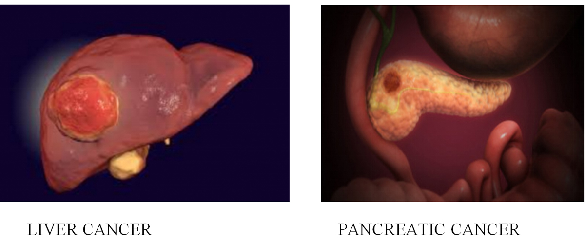 Breast Cancer Treatment in Chennai ,Thyroid  Cancer Treatment in Chennai, Surgical Oncologist Cancer Treatment in Chennai, Gastroenterology  in Chennai, Laparoscopic Surgery in Chennai,  Dentist in Chennai, Dental Clinic in Chennai, Dental in Chennai, Root Canal Treatment in Chennai,  endocrinologist in Chennai, Psychiatrist  in Chennai  Endodontist in Chennai, Breast Cancer Treatment in Purasawalkam Chennai ,Thyroid  Cancer Treatment in Purasawalkam Chennai, Surgical Oncologist Cancer Treatment in Purasawalkam Chennai, Gastroenterology  in Purasawalkam Chennai, Laparoscopic Surgery in Purasawalkam Chennai,  Dentist in Purasawalkam Chennai, Dental Clinic in Purasawalkam Chennai, Dental in Purasawalkam Chennai, Root Canal Treatment in Purasawalkam Chennai,  endocrinologist in Purasawalkam Chennai, Psychiatrist  in Purasawalkam Chennai  Endodontist in Purasawalkam Chennai, Breast Cancer Treatment in Vepery Chennai  ,Thyroid  Cancer Treatment in Vepery Chennai, Surgical Oncologist Cancer Treatment in Vepery Chennai, Gastroenterology  in Vepery Chennai, Laparoscopic Surgery in Vepery Chennai,  Dentist in Vepery Chennai, Dental Clinic in Vepery Chennai, Dental in Vepery Chennai, Root Canal Treatment in Vepery Chennai,  endocrinologist in Vepery Chennai, Psychiatrist  in Vepery Chennai  Endodontist in Vepery Chennai, , Breast Cancer Treatment in kilpauk Chennai  ,Thyroid  Cancer Treatment in kilpauk Chennai, Surgical Oncologist Cancer Treatment in kilpauk Chennai, Gastroenterology  in kilpauk Chennai, Laparoscopic Surgery in kilpauk Chennai,  Dentist in kilpauk Chennai, Dental Clinic in kilpauk Chennai, Dental in kilpauk Chennai, Root Canal Treatment in kilpauk Chennai,  endocrinologist in kilpauk Chennai, Psychiatrist  in kilpauk Chennai,  Endodontist in kilpauk Chennai, Breast Cancer Treatment in kellys Chennai  ,Thyroid  Cancer Treatment in kellys Chennai, Surgical Oncologist Cancer Treatment in kellys Chennai, Gastroenterology  in kellys Chennai, Laparoscopic Surgery in kellys Chennai,  Dentist in kellys Chennai, Dental Clinic in kellys Chennai, Dental in kellys Chennai, Root Canal Treatment in kellys Chennai,  endocrinologist in kellys Chennai, Psychiatrist  in kellys Chennai,  Endodontist in kellys Chennai