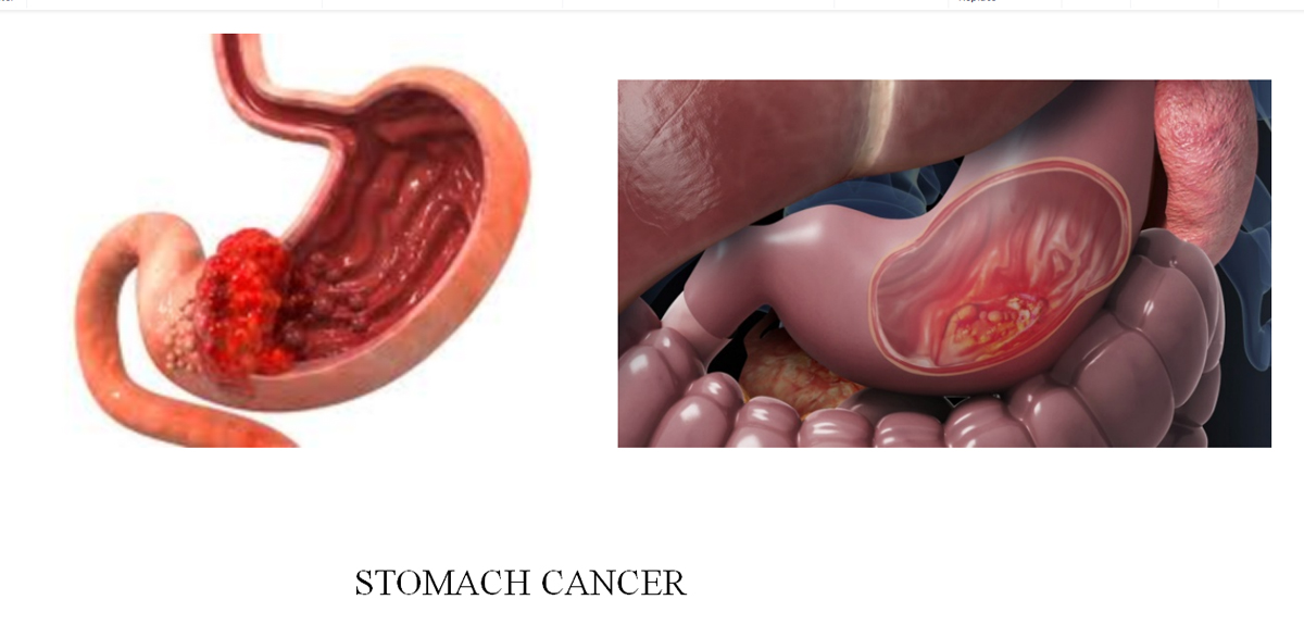 Breast Cancer Treatment in Chennai ,Thyroid  Cancer Treatment in Chennai, Surgical Oncologist Cancer Treatment in Chennai, Gastroenterology  in Chennai, Laparoscopic Surgery in Chennai,  Dentist in Chennai, Dental Clinic in Chennai, Dental in Chennai, Root Canal Treatment in Chennai,  endocrinologist in Chennai, Psychiatrist  in Chennai  Endodontist in Chennai, Breast Cancer Treatment in Purasawalkam Chennai ,Thyroid  Cancer Treatment in Purasawalkam Chennai, Surgical Oncologist Cancer Treatment in Purasawalkam Chennai, Gastroenterology  in Purasawalkam Chennai, Laparoscopic Surgery in Purasawalkam Chennai,  Dentist in Purasawalkam Chennai, Dental Clinic in Purasawalkam Chennai, Dental in Purasawalkam Chennai, Root Canal Treatment in Purasawalkam Chennai,  endocrinologist in Purasawalkam Chennai, Psychiatrist  in Purasawalkam Chennai  Endodontist in Purasawalkam Chennai, Breast Cancer Treatment in Vepery Chennai  ,Thyroid  Cancer Treatment in Vepery Chennai, Surgical Oncologist Cancer Treatment in Vepery Chennai, Gastroenterology  in Vepery Chennai, Laparoscopic Surgery in Vepery Chennai,  Dentist in Vepery Chennai, Dental Clinic in Vepery Chennai, Dental in Vepery Chennai, Root Canal Treatment in Vepery Chennai,  endocrinologist in Vepery Chennai, Psychiatrist  in Vepery Chennai  Endodontist in Vepery Chennai, , Breast Cancer Treatment in kilpauk Chennai  ,Thyroid  Cancer Treatment in kilpauk Chennai, Surgical Oncologist Cancer Treatment in kilpauk Chennai, Gastroenterology  in kilpauk Chennai, Laparoscopic Surgery in kilpauk Chennai,  Dentist in kilpauk Chennai, Dental Clinic in kilpauk Chennai, Dental in kilpauk Chennai, Root Canal Treatment in kilpauk Chennai,  endocrinologist in kilpauk Chennai, Psychiatrist  in kilpauk Chennai,  Endodontist in kilpauk Chennai, Breast Cancer Treatment in kellys Chennai  ,Thyroid  Cancer Treatment in kellys Chennai, Surgical Oncologist Cancer Treatment in kellys Chennai, Gastroenterology  in kellys Chennai, Laparoscopic Surgery in kellys Chennai,  Dentist in kellys Chennai, Dental Clinic in kellys Chennai, Dental in kellys Chennai, Root Canal Treatment in kellys Chennai,  endocrinologist in kellys Chennai, Psychiatrist  in kellys Chennai,  Endodontist in kellys Chennai